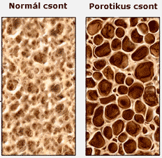 osteoporosis_csontok
